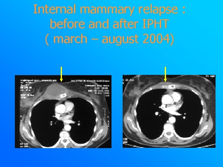 Internal mammary relapse : before and after IPHT ( march – august 2004) 