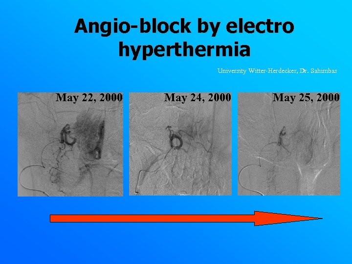 Angio-block by electro hyperthermia University Witter-Herdecker, Dr. Sahimbas May 22, 2000 May 24, 2000