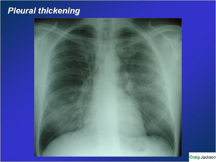 Pleural thickening 