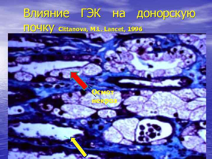 Влияние ГЭК на донорскую почку Cittanova, M. L. Lancet, 1996 Осмот некроз 