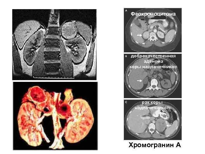 Феохромоцитома доброкачественная аденома коры надпочечников рак коры надпочечников Хромогранин А 