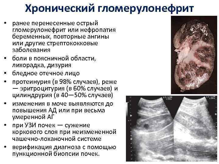 Хронический гломерулонефрит • ранее перенесенные острый гломерулонефрит или нефропатия беременных, повторные ангины или другие