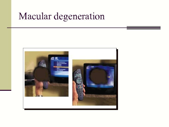 Macular degeneration 