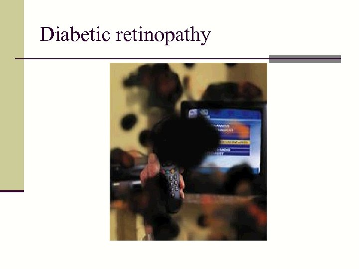 Diabetic retinopathy 