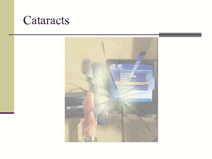 Cataracts 