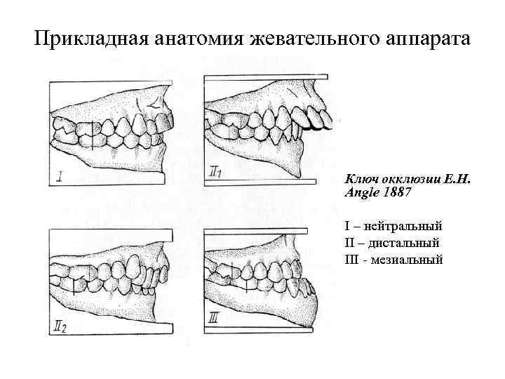 Ключ окклюзии. Ключи окклюзии по Эндрюсу. 6 Ключей окклюзии по Энглю. 6 Ключей нормальной окклюзии по Эндрюсу. Ключи окклюзии по Энглю и Эндрюсу.