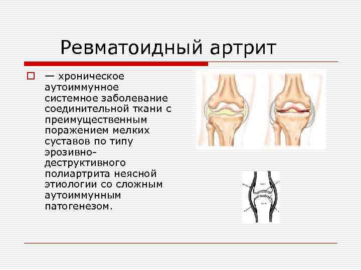 Полиартрит ревматоидный карта вызова