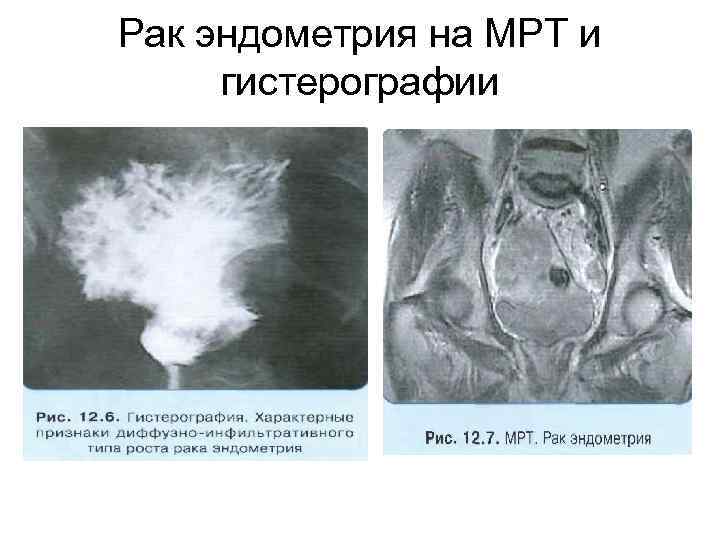 Рак эндометрия на МРТ и гистерографии 