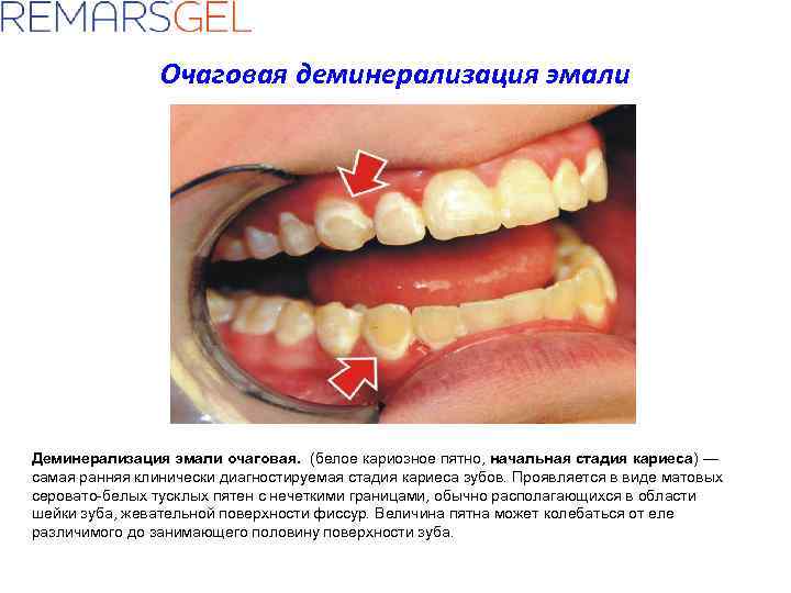 Очаговая деминерализация эмали Деминерализация эмали очаговая. (белое кариозное пятно, начальная стадия кариеса) — самая