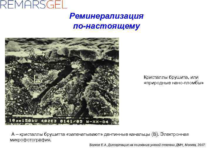 Реминерализация по-настоящему Кристаллы брушита, или «природные нано-пломбы» А – кристаллы брушитта «запечатывают» дентинные канальцы