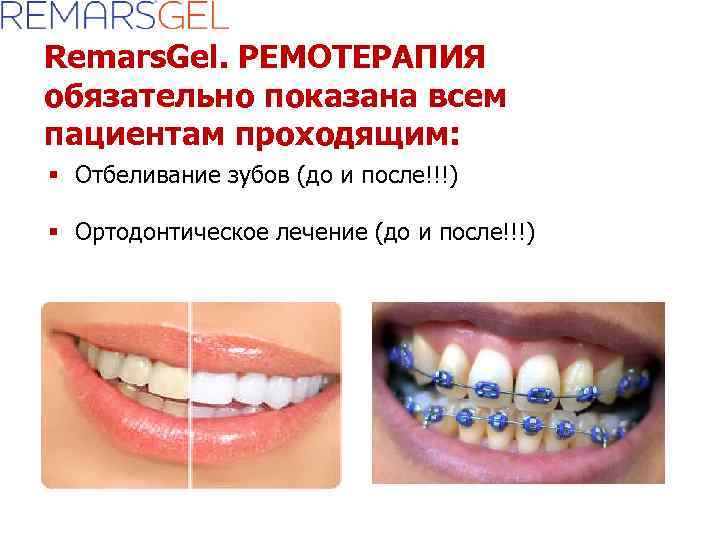 Remars. Gel. РЕМОТЕРАПИЯ обязательно показана всем пациентам проходящим: § Отбеливание зубов (до и после!!!)