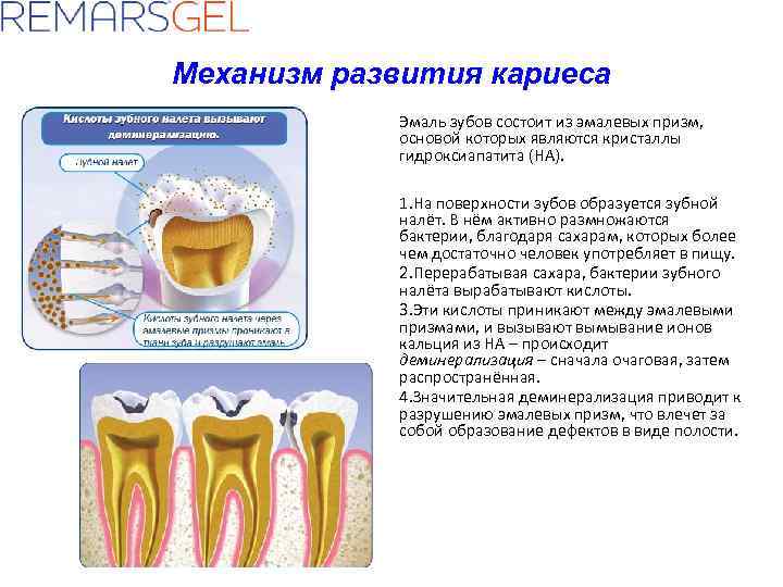 Деминерализация эмали фото