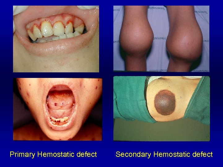 Primary Hemostatic defect Secondary Hemostatic defect 