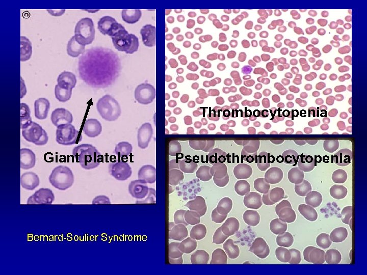 Thrombocytopenia Giant platelet Bernard-Soulier Syndrome Pseudothrombocytopenia 