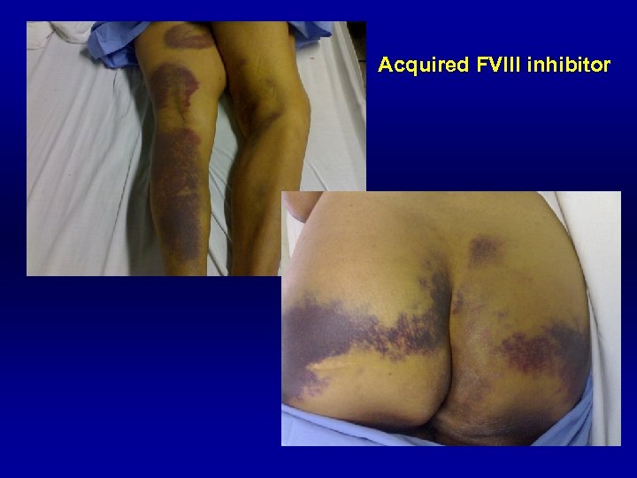 Acquired FVIII inhibitor 