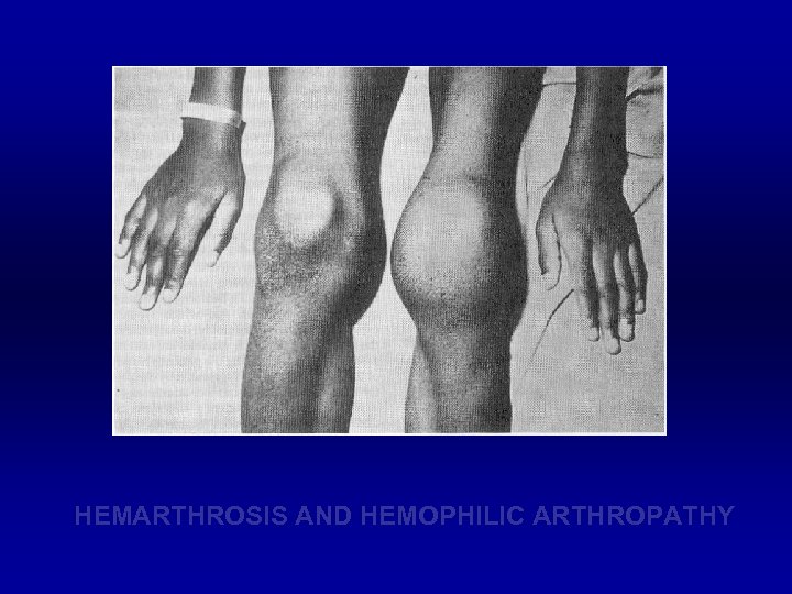 HEMARTHROSIS AND HEMOPHILIC ARTHROPATHY 