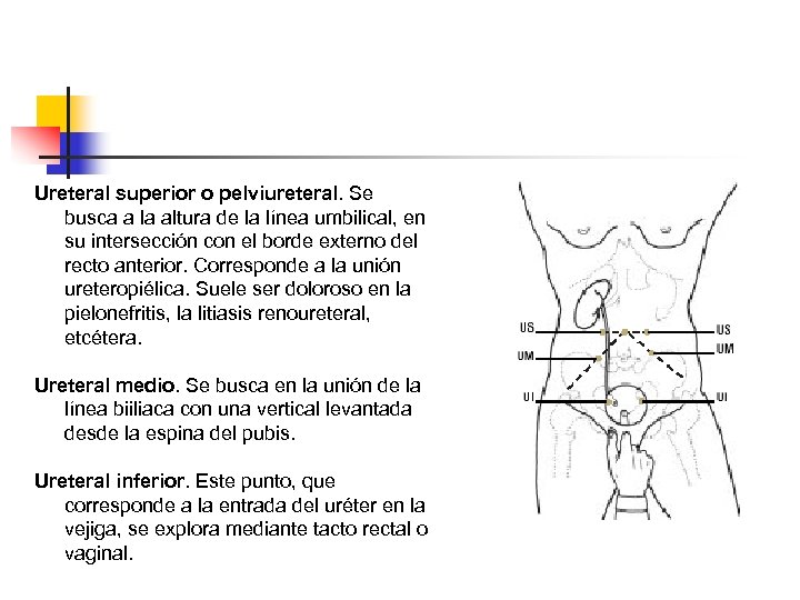 Ureteral superior o pelviureteral. Se busca a la altura de la línea umbilical, en