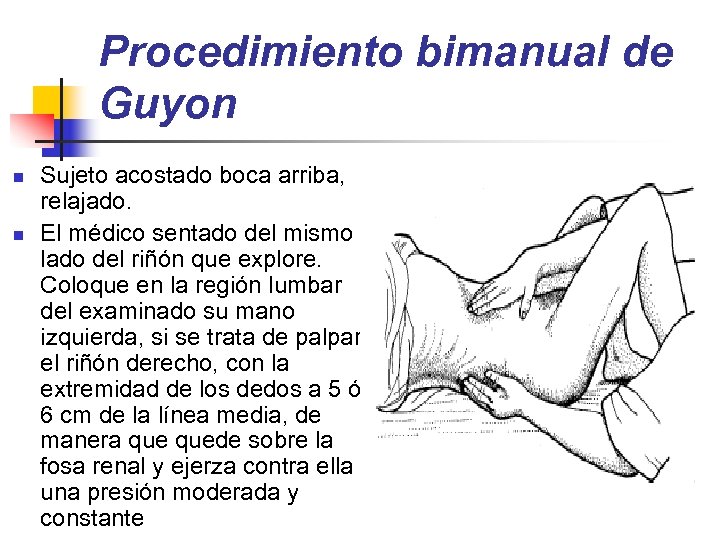 Procedimiento bimanual de Guyon n n Sujeto acostado boca arriba, relajado. El médico sentado