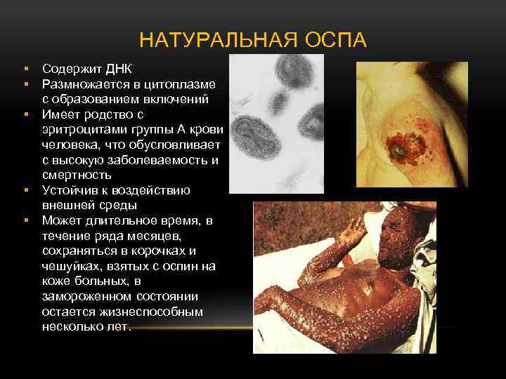НАТУРАЛЬНАЯ ОСПА § § § Содержит ДНК Размножается в цитоплазме с образованием включений Имеет