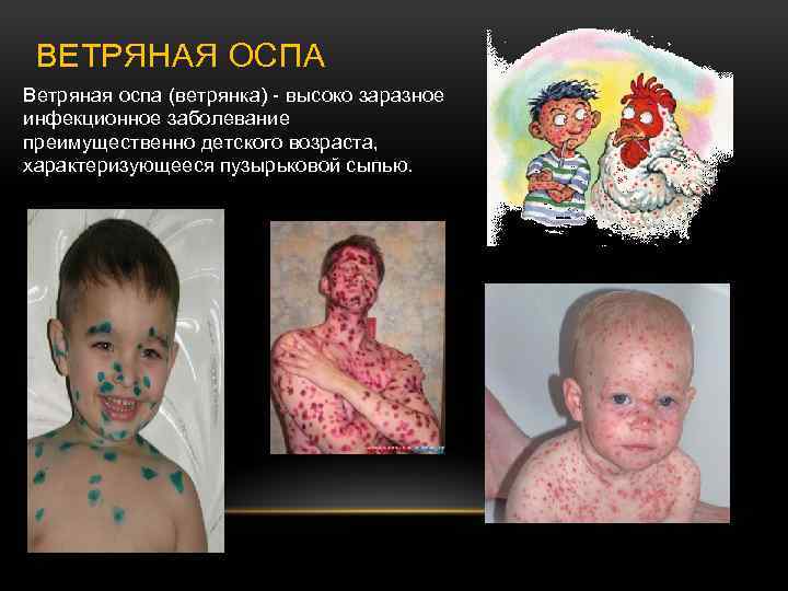 ВЕТРЯНАЯ ОСПА Ветряная оспа (ветрянка) - высоко заразное инфекционное заболевание преимущественно детского возраста, характеризующееся