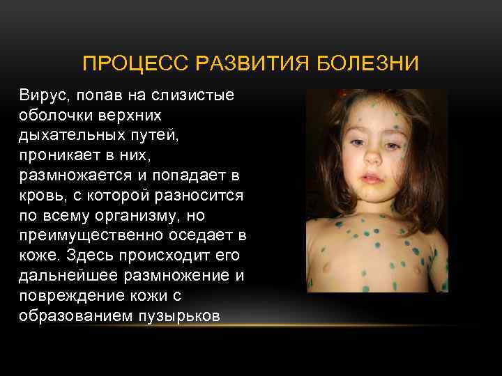 ПРОЦЕСС РАЗВИТИЯ БОЛЕЗНИ Вирус, попав на слизистые оболочки верхних дыхательных путей, проникает в них,