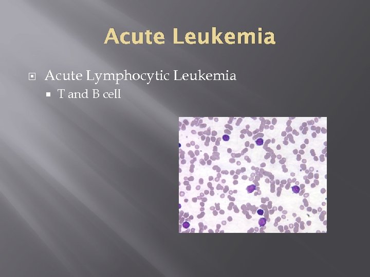 Acute Leukemia Acute Lymphocytic Leukemia T and B cell 