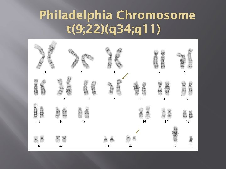 Philadelphia Chromosome t(9; 22)(q 34; q 11) 