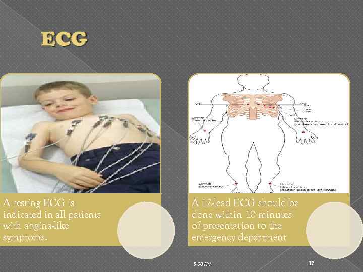 ECG A resting ECG is indicated in all patients with angina-like symptoms. A 12