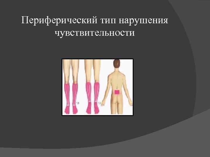 Периферический тип нарушения чувствительности 