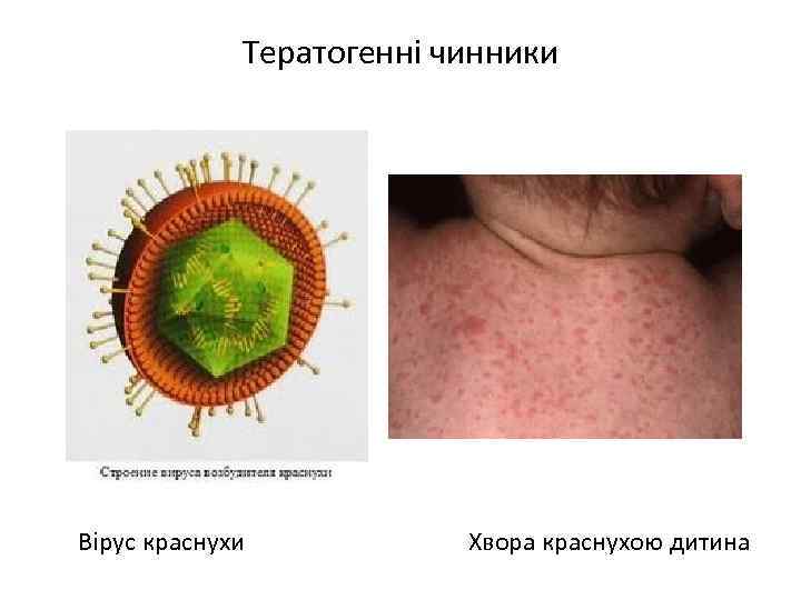 Тератогенні чинники Вірус краснухи Хвора краснухою дитина 