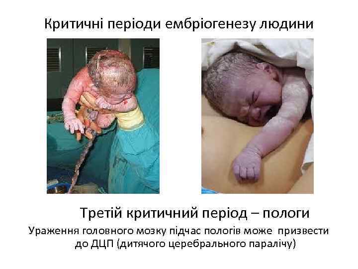 Критичні періоди ембріогенезу людини Третій критичний період – пологи Ураження головного мозку підчас пологів