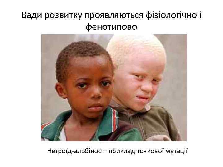 Вади розвитку проявляються фізіологічно і фенотипово Негроїд-альбінос – приклад точкової мутації 