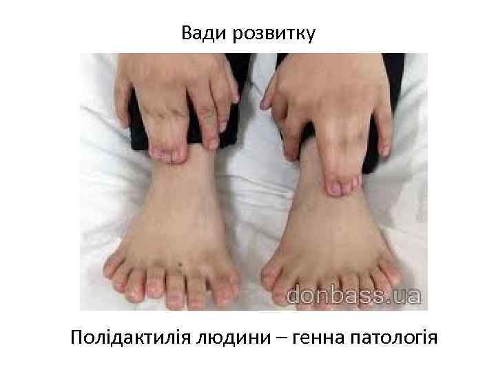 Вади розвитку Полідактилія людини – генна патологія 
