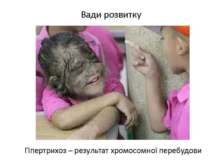 Вади розвитку Гіпертрихоз – результат хромосомної перебудови 