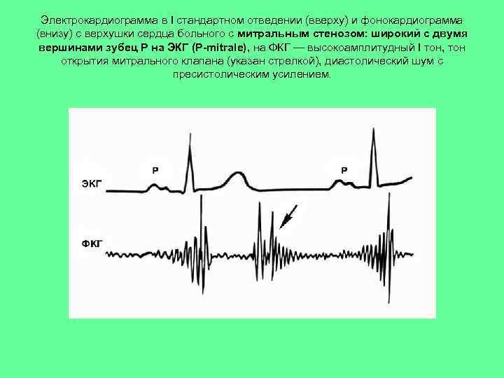 Электрокардиограмма в I стандартном отведении (вверху) и фонокардиограмма (внизу) с верхушки сердца больного с