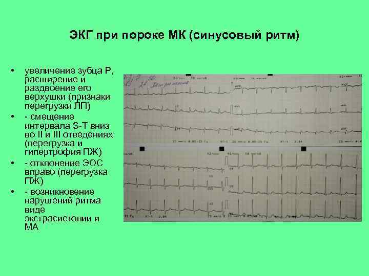 ЭКГ при пороке МК (синусовый ритм) • • увеличение зубца Р, расширение и раздвоение