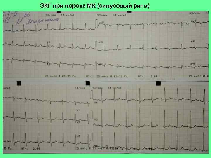 ЭКГ при пороке МК (синусовый ритм) 