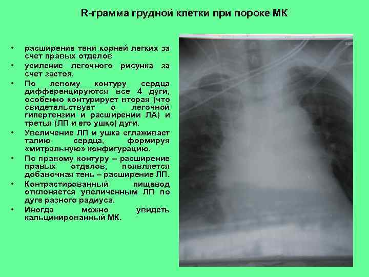 R-грамма грудной клетки при пороке МК • • расширение тени корней легких за счет