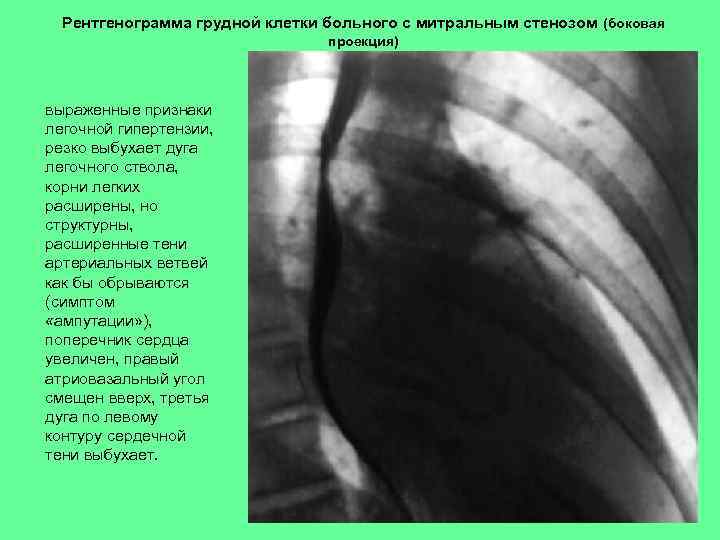 Рентгенограмма грудной клетки больного с митральным стенозом (боковая проекция) выраженные признаки легочной гипертензии, резко