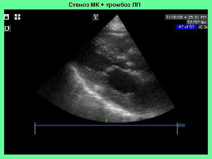 Стеноз МК + тромбоз ЛП 