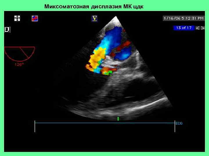 Миксоматозная дисплазия МК цдк 