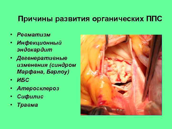 Причины развития органических ППС • Ревматизм • Инфекционный эндокардит • Дегенеративные изменения (синдром Марфана,