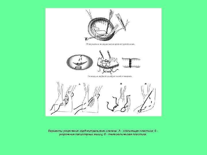 Варианты укорочения хорд митрального клапана: А - скользящая пластика: Б укорочение папиллярных мышц; В