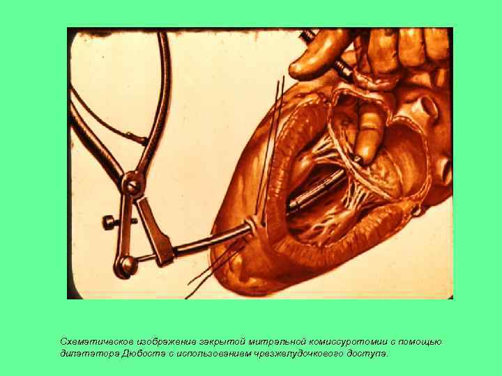 Схематическое изображение закрытой митральной комиссуротомии с помощью дилататора Дюбоста с использованием чрезжелудочкового доступа. 