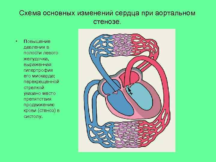 Схема основных изменений сердца при аортальном стенозе. • Повышение давления в полости левого желудочка,