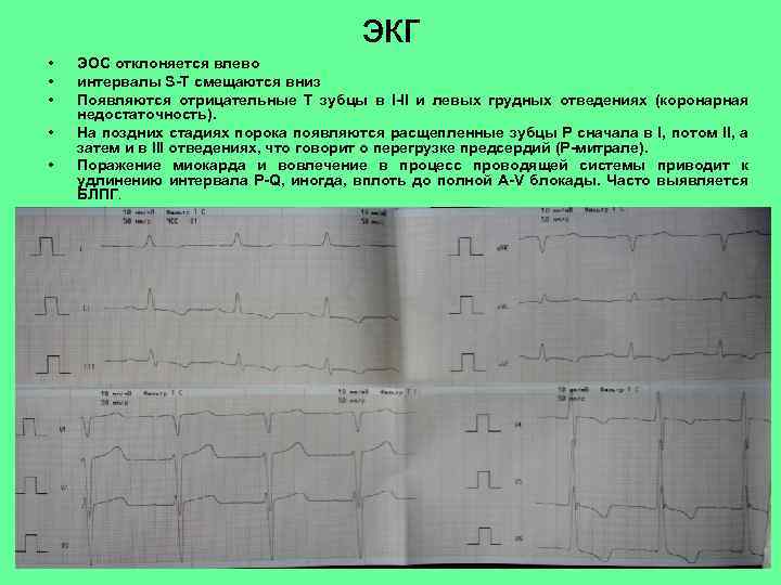 экг • • • ЭОС отклоняется влево интервалы S-T смещаются вниз Появляются отрицательные Т