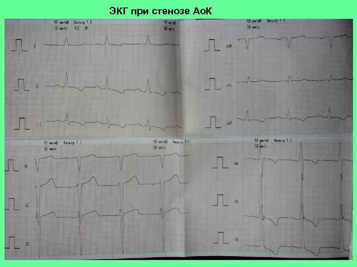 ЭКГ при стенозе Ао. К 