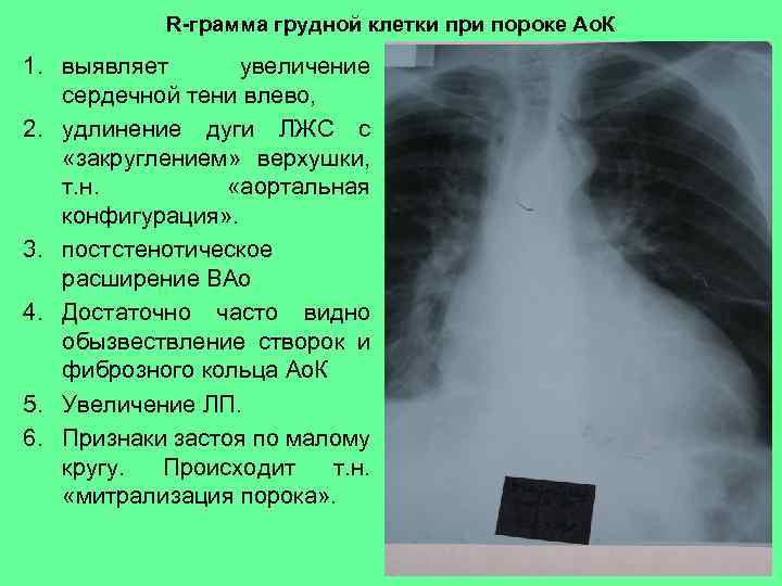 R-грамма грудной клетки при пороке Ао. К 1. выявляет увеличение сердечной тени влево, 2.