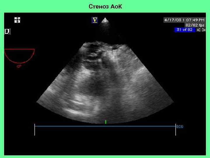 Стеноз Ао. К 