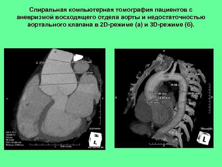 Спиральная компьютерная томография пациентов с аневризмой восходящего отдела аорты и недостаточностью аортального клапана в